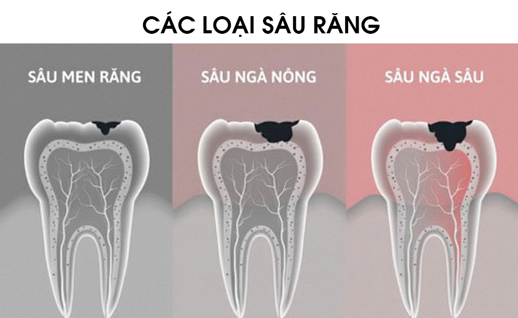 Sâu Răng | Nha khoa Smile Up